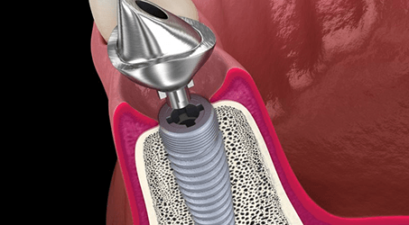 a digital illustration of a dental implant and abutment