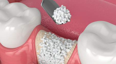 a graphic rendering of grafting material being placed in the jawbone area