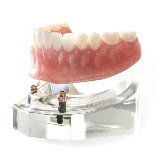 Model dental implant supported denture