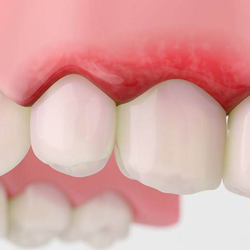 Closeup rendering of inflamed gums