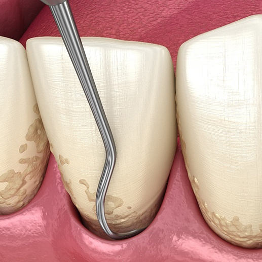 Closeup rendering of dental instrument cleaning pocket of gums