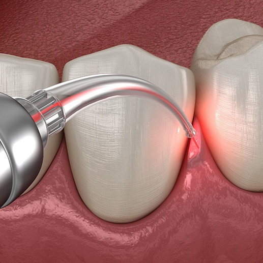 Rendering of laser removing damaged gum tissues in a lower arch