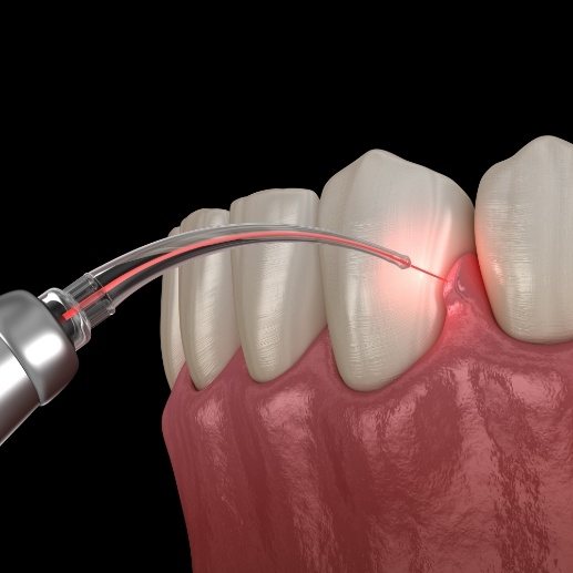 Animated smile during laser periodontal therapy