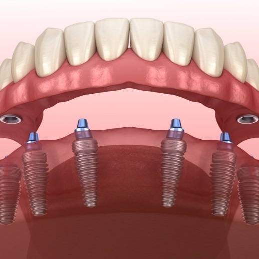 Animated smile during dental implant placement