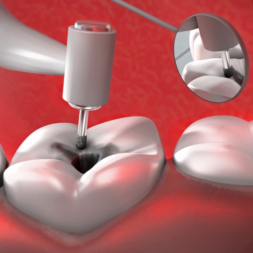 Animated smile during root canal treatment