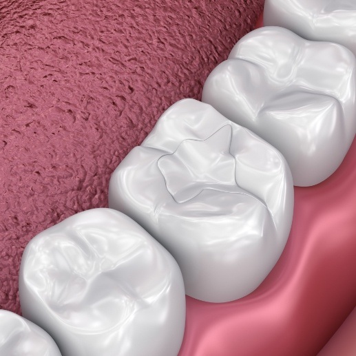 Animated smile with dental sealants