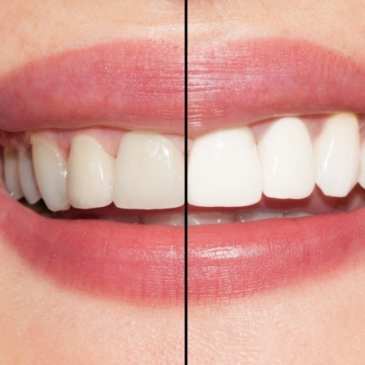 Closeup of smile before and after teeth whitening