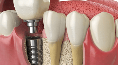 a 3D digital illustration of a dental implant undergoing osseointegration