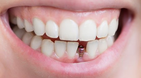 A smile that has just received a dental implant