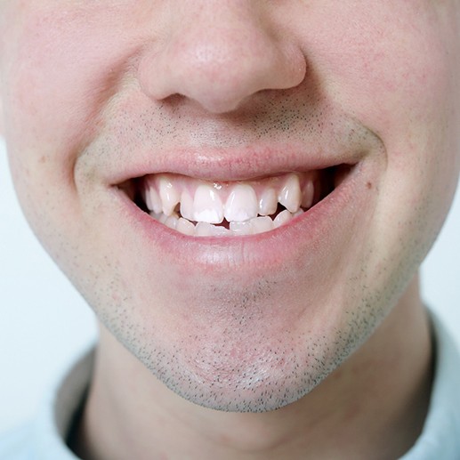 A close-up of a man’s crooked smile