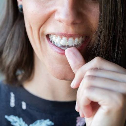 A beautiful woman wearing an Invisalign tray