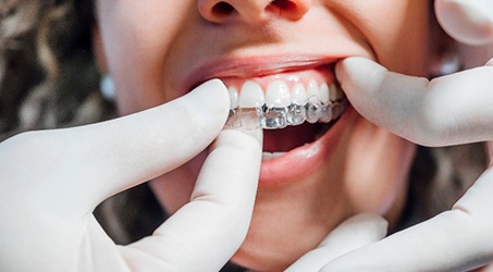 Springdale dentist placing Invisalign aligner on patient's top teeth