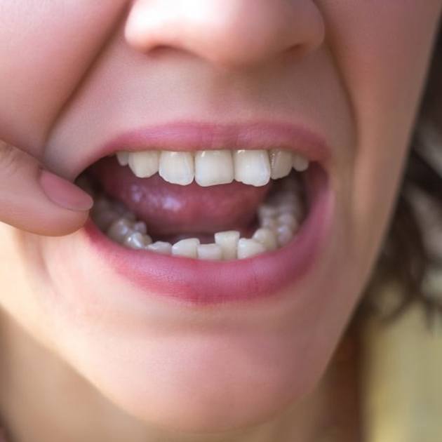 a person pointing at their crooked teeth