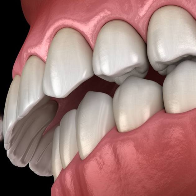 a 3 D illustration of an overbite