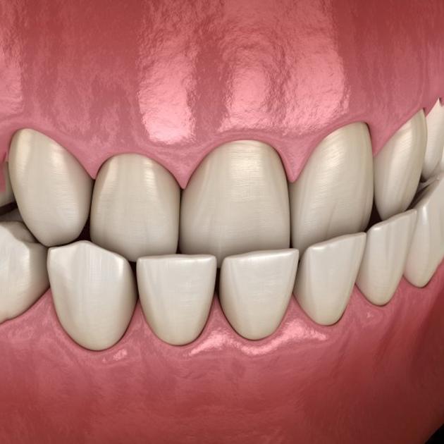 a 3 D illustration of an underbite