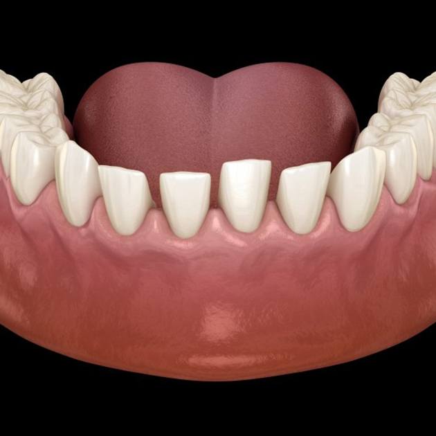 a 3 D illustration of gapped teeth