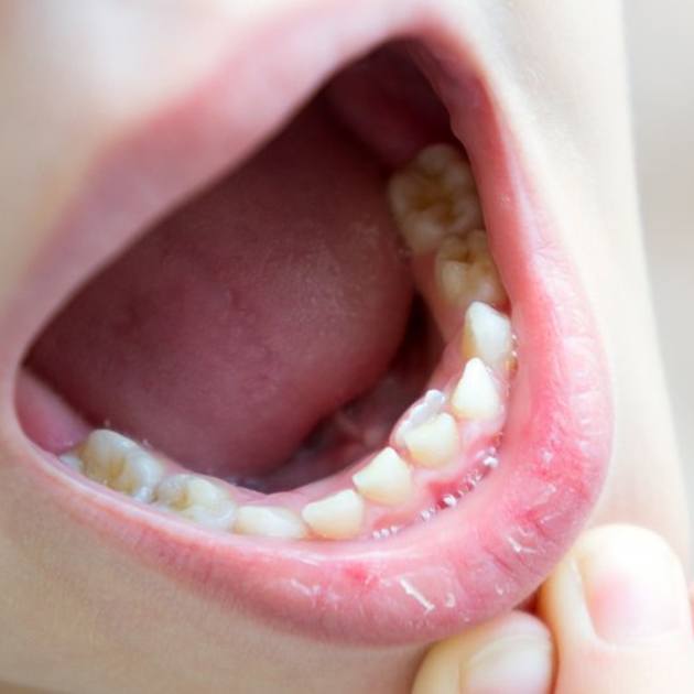  patient with baby and permanent teeth