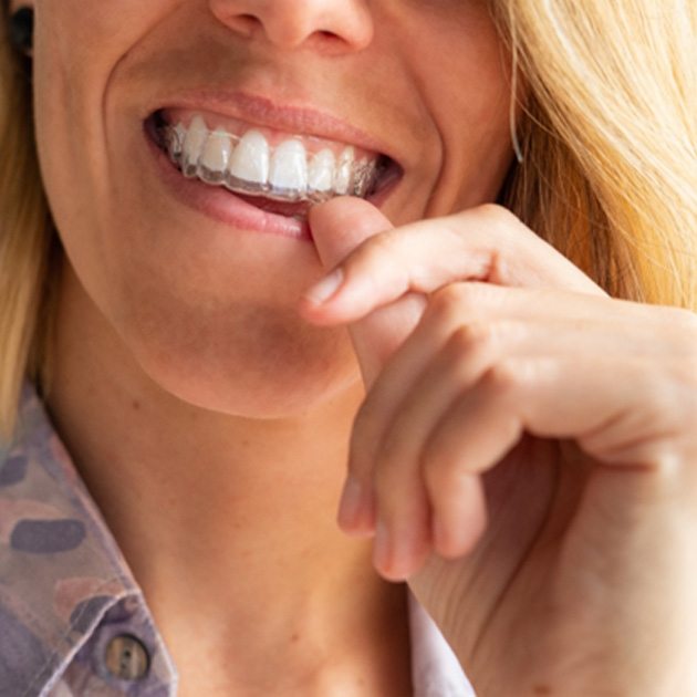 Woman putting in Invisalign aligner