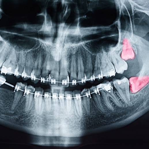 Example of wisdom tooth in Springdale