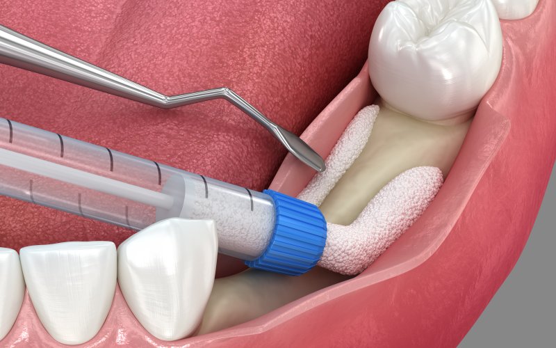 A 3D illustration of the bone grafting process