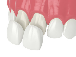 Veneers being placed on front teeth