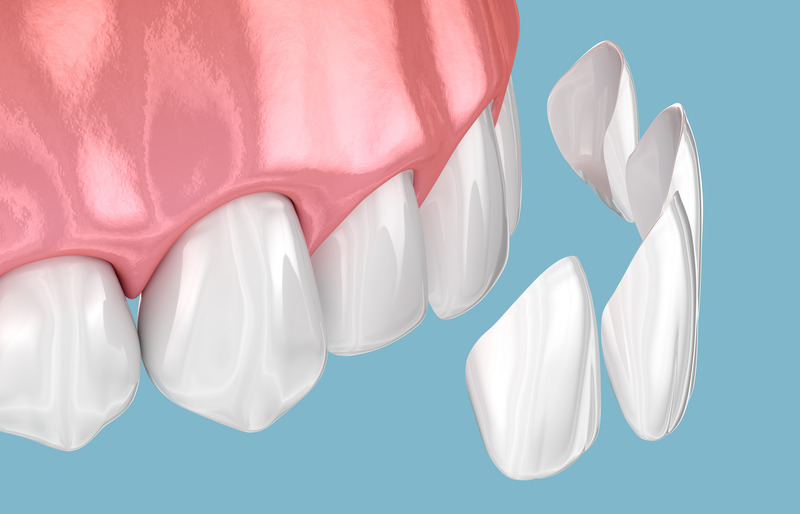 A 3D illustration of veneers being placed over teeth