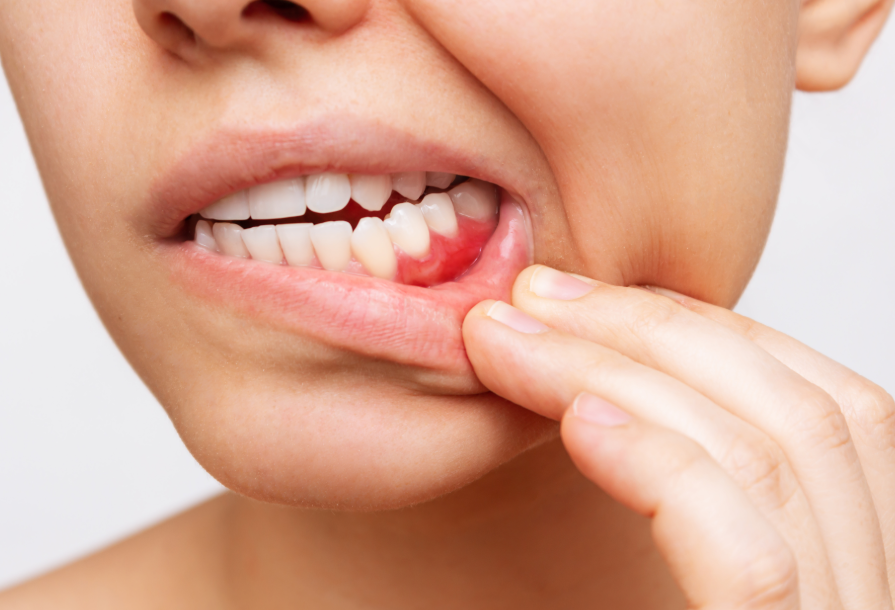 Close up of woman showing inflamed gums